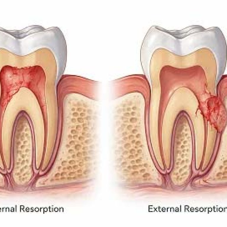 Internal-vs-External-Resorption