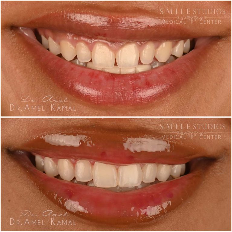 fillings-bondings (22)
