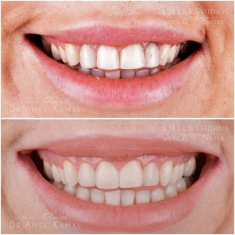 fillings-bondings (8)