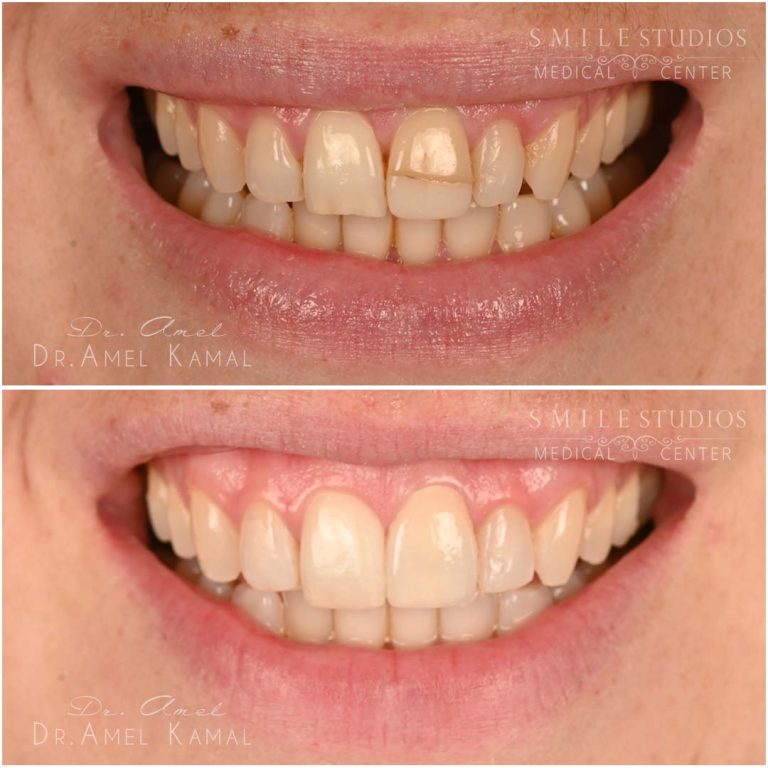 single-tooth (8)